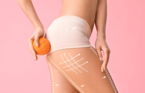 Woman holds orange up to her buttocks, representing stubborn cellulite, before her Morpheus8® treatment
