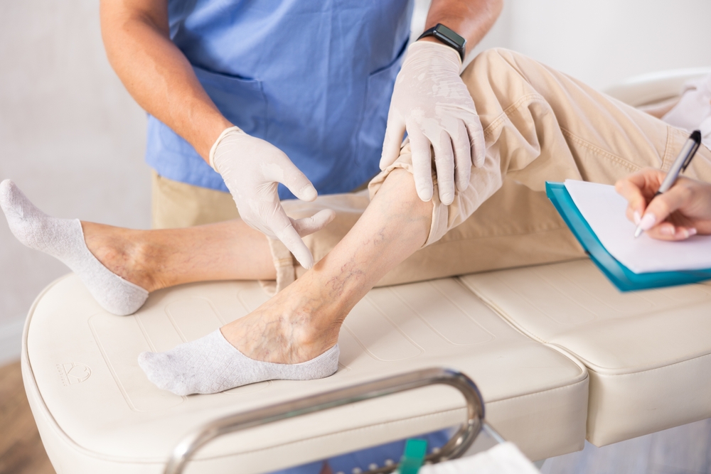 Varicose Vein Removal Abingdon VA