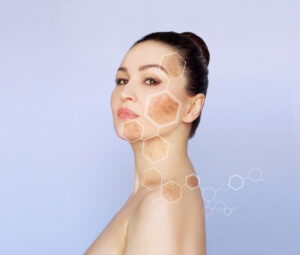 Woman with her hair in a bun shows her side profile, revealing brown blotches of discoloration on her cheeks before her IPL treatment