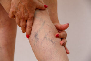 Elderly woman shows her varicose veins before her vein treatment