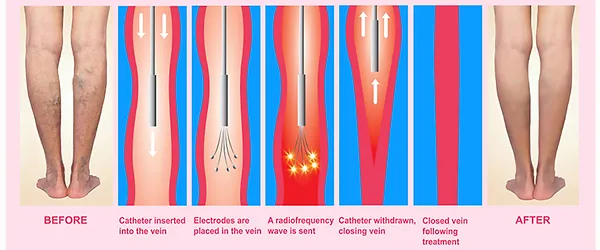 Endovenous laser vein ablation diagram
