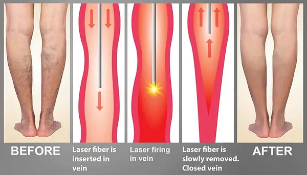 Radiofrequency vein ablation diagram
