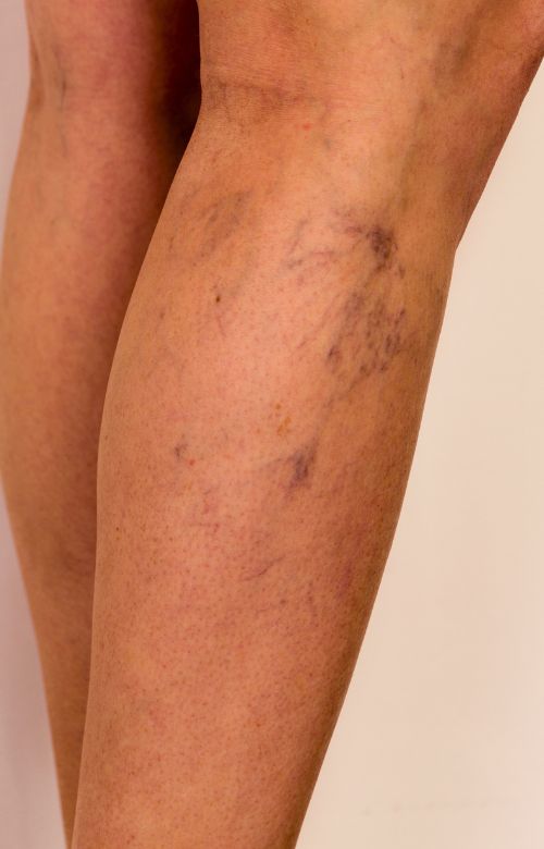 Spider vein treatment for visible veins on the leg and ankle