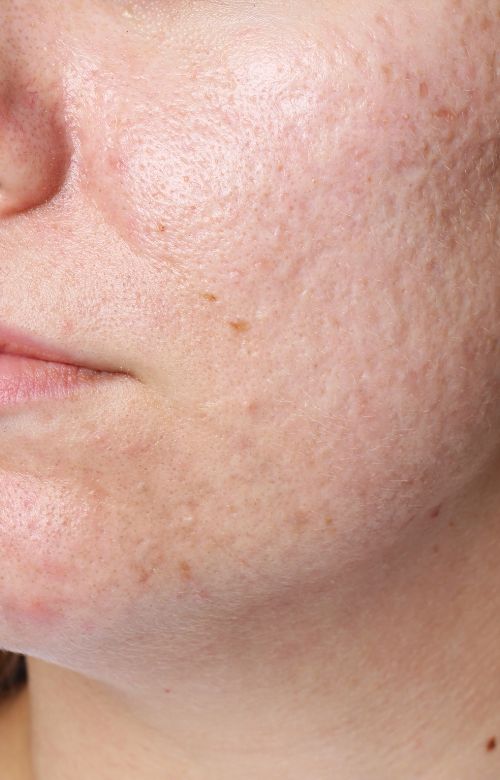 Acne Scar Treatment at Living Water Vein Institute and Medical Spa