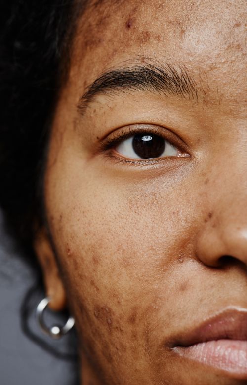 Acne Treatment at Living Water Vein Institute and Medical Spa