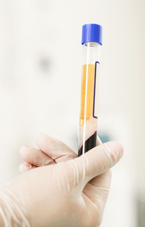 PRP Injections at Living Water Vein Institute and Medical Spa