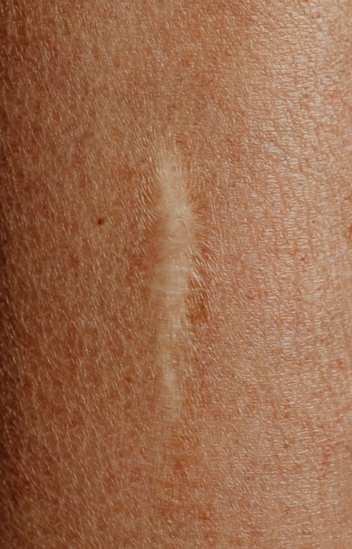 Scar revision consultation at Living Water Medical Spa