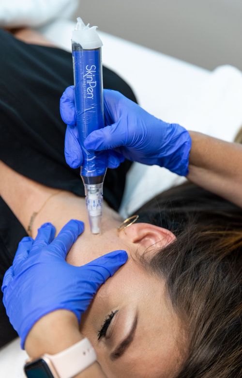 SkinPen Microneedling at Living Water Vein Institute and Medical Spa