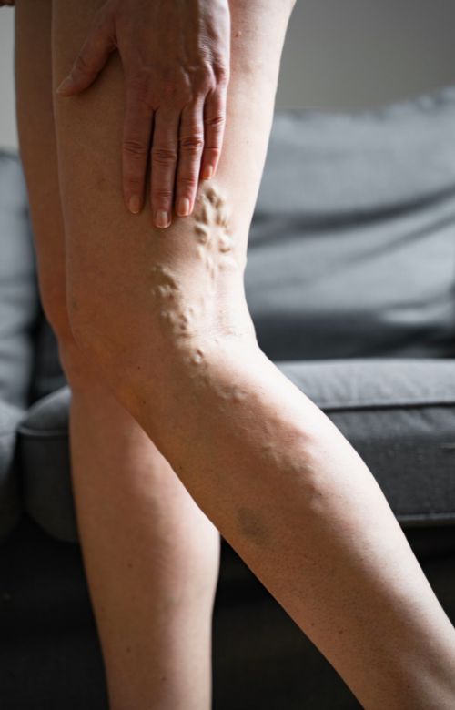 Varicose veins on legs Living Water Vein Institute